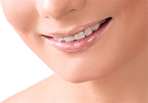 How Magic Smile Teeth Braces can Enhance Your Smile and Boost Confidence